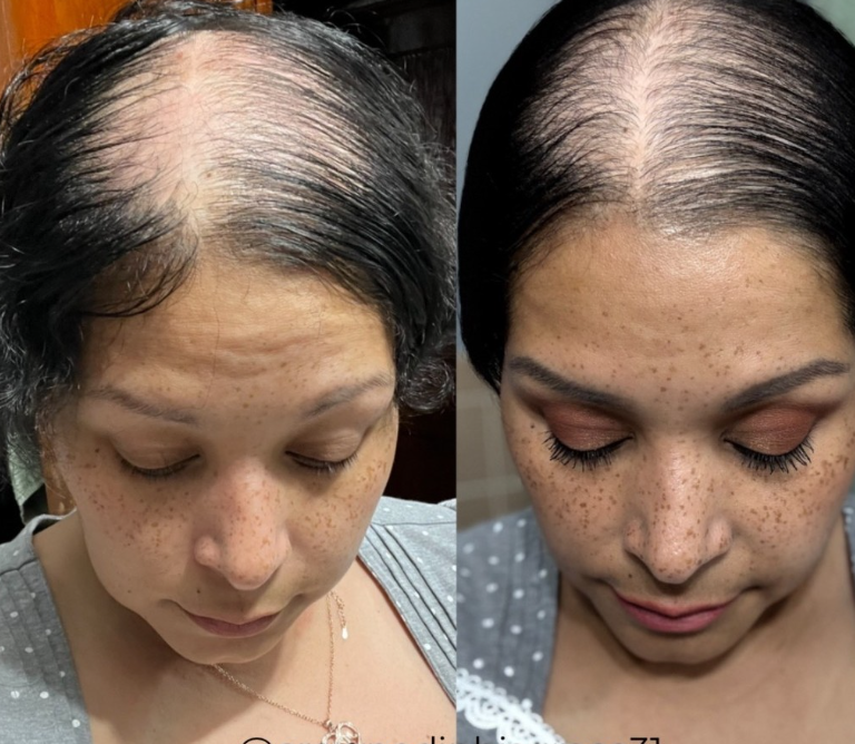 Hair growth 6 weeks transformation with Monat  